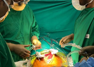 Pune's First LVAD Surgery