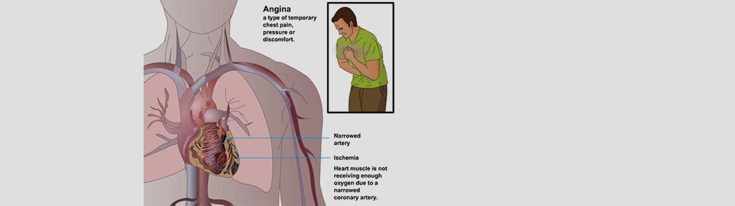 Angina Pectoris