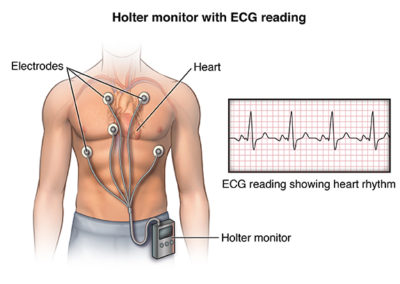 Front view male figure torso with holter monitor and ekg/heart rhythm inset
