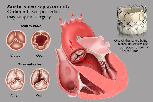 What Not To Eat After Aortic Valve Replacement